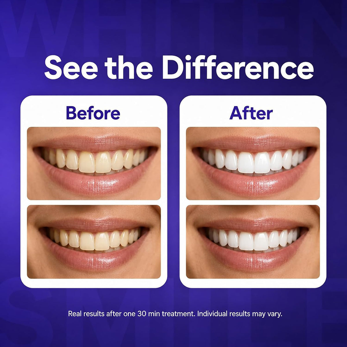 Dent Teeth Whitening Strips, Purple Teeth Whitening Strips, 14 Count Kit